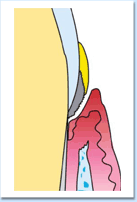 図：歯周病2