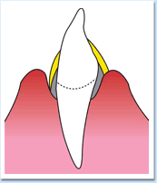 図：歯周病3
