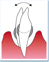 図：歯周病4