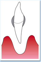 図：歯周病5
