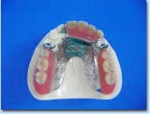 金属床義歯1