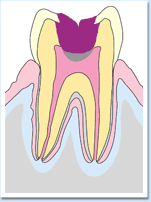 図：う蝕が歯髄に進行