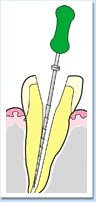 図：白い歯または銀歯を入れる