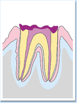 図：虫歯が進行して、根まで壊してしまった状態